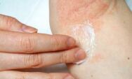                 SUS amplia tratamento da dermatite at&oacute;pica com novas medica&ccedil;&otilde;es