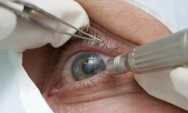 Conselho de Oftalmologia alerta para riscos e uso restrito de cirurgia que muda cor dos olhos
