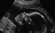 Adolescente asfixia e joga beb&ecirc; prematuro no lixo ao for&ccedil;ar aborto
