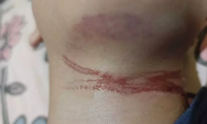 Menino de 10 anos sofre ferimento no pesco&ccedil;o ap&oacute;s se enroscar em fio solto ao sair de escola
