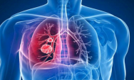 Tuberculose: longe de ser coisa do passado, doen&ccedil;a volta a preocupar o Brasil