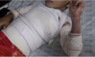 Queimaduras em crian&ccedil;as aumentam nas f&eacute;rias e maioria dos casos ocorre em casa