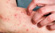  Porto Alegre confirma primeiro caso de Mpox em 2026