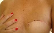 Agora &eacute; lei: SUS passa a garantir cirurgia de reconstru&ccedil;&atilde;o mam&aacute;ria para todas as mulheres