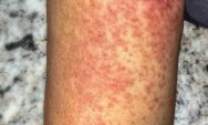 Coxim registra 1&ordm; caso confirmado de chikungunya e acende alerta ap&oacute;s emerg&ecirc;ncia em Dourados