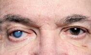 Glaucoma: doen&ccedil;a silenciosa pode causar perda irrevers&iacute;vel da vis&atilde;o se n&atilde;o for tratada