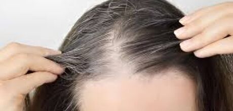 Queda de cabelo por canetas emagrecedoras: entenda causas e como tratar
