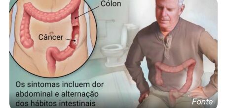 C&acirc;ncer colorretal: o tumor silencioso que agora atinge cada vez mais brasileiros com menos de 50 ano