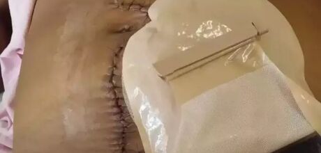 Mulher com gaze esquecida no corpo ap&oacute;s parto agora vive com colostomia em MS