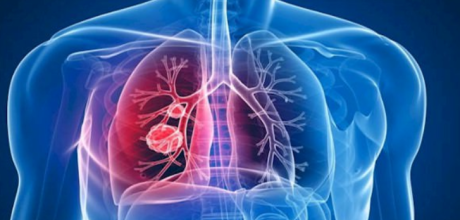 Tuberculose: longe de ser coisa do passado, doen&ccedil;a volta a preocupar o Brasil