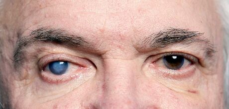 Glaucoma: doen&ccedil;a silenciosa pode causar perda irrevers&iacute;vel da vis&atilde;o se n&atilde;o for tratada