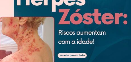 Herpes-z&oacute;ster acende alerta em Coxim ap&oacute;s moradores procurarem reportagem com relatos da doen&ccedil;a