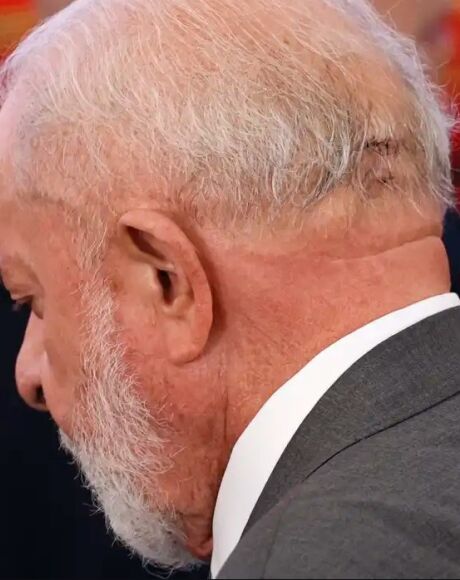 Hemorragia n&atilde;o afeta fun&ccedil;&atilde;o cerebral do presidente, diz m&eacute;dico de Lula