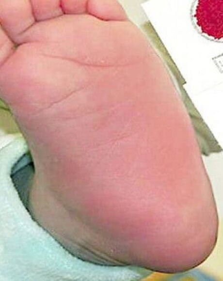 Mato Grosso do Sul lan&ccedil;a plano para fortalecer atendimento a pacientes com Doen&ccedil;a Falciforme
