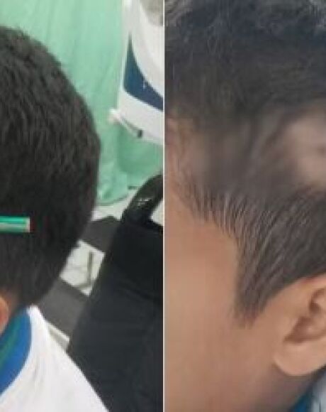 Estudante crava l&aacute;pis na cabe&ccedil;a de colega ap&oacute;s briga dentro de escola