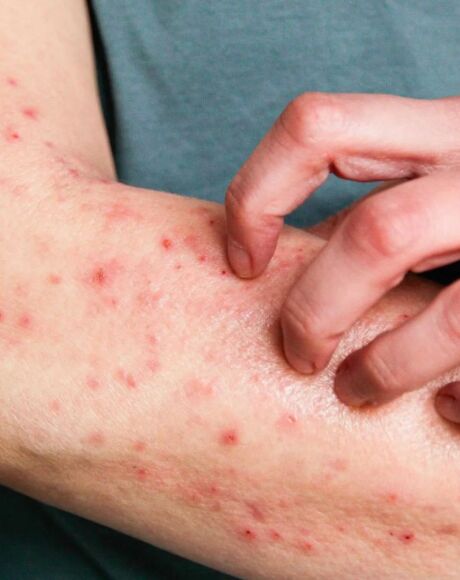  Porto Alegre confirma primeiro caso de Mpox em 2026