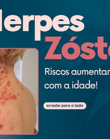 Herpes-z&oacute;ster acende alerta em Coxim ap&oacute;s moradores procurarem reportagem com relatos da doen&ccedil;a