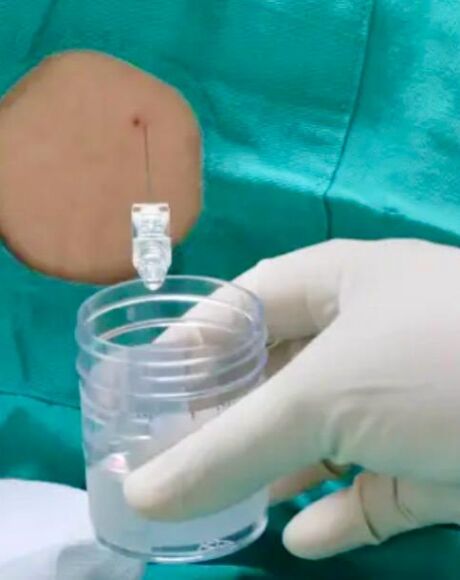 Mato Grosso do Sul registra 34 casos de meningite e 8 mortes em 2026, mas SES descarta surto