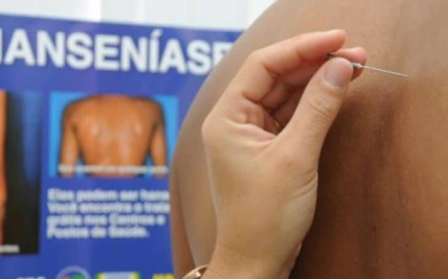 Janeiro Roxo: Saúde de MS intensifica combate à hanseníase e reforça o diagnóstico precoce
