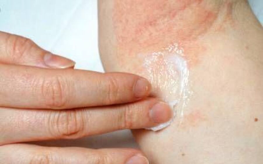                 SUS amplia tratamento da dermatite atópica com novas medicações