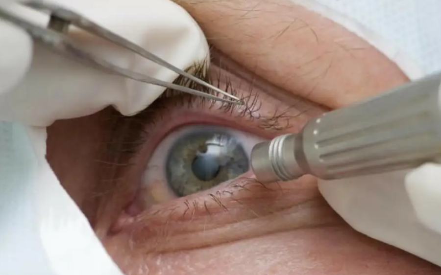 Conselho de Oftalmologia alerta para riscos e uso restrito de cirurgia que muda cor dos olhos
