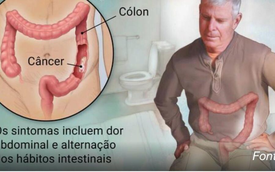 Câncer colorretal: o tumor silencioso que agora atinge cada vez mais brasileiros com menos de 50 ano