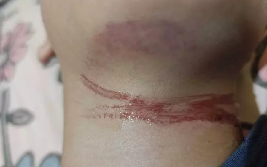 Menino de 10 anos sofre ferimento no pescoço após se enroscar em fio solto ao sair de escola
