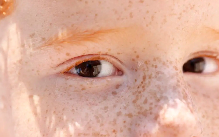 Leucocoria: Reflexo branco nos olhos de bebês pode indicar problemas graves e requer exame imediato
