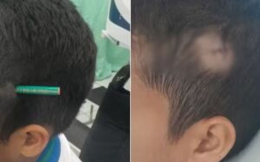 Estudante crava lápis na cabeça de colega após briga dentro de escola