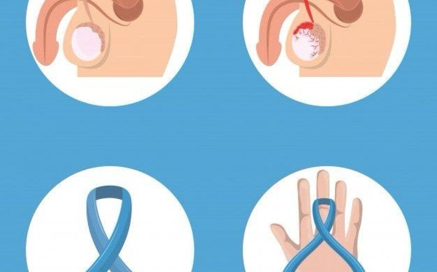 Ótima Notícia: Cirurgia Robótica para Câncer de Próstata Será Oferecida pelo SUS em Até 6 Meses