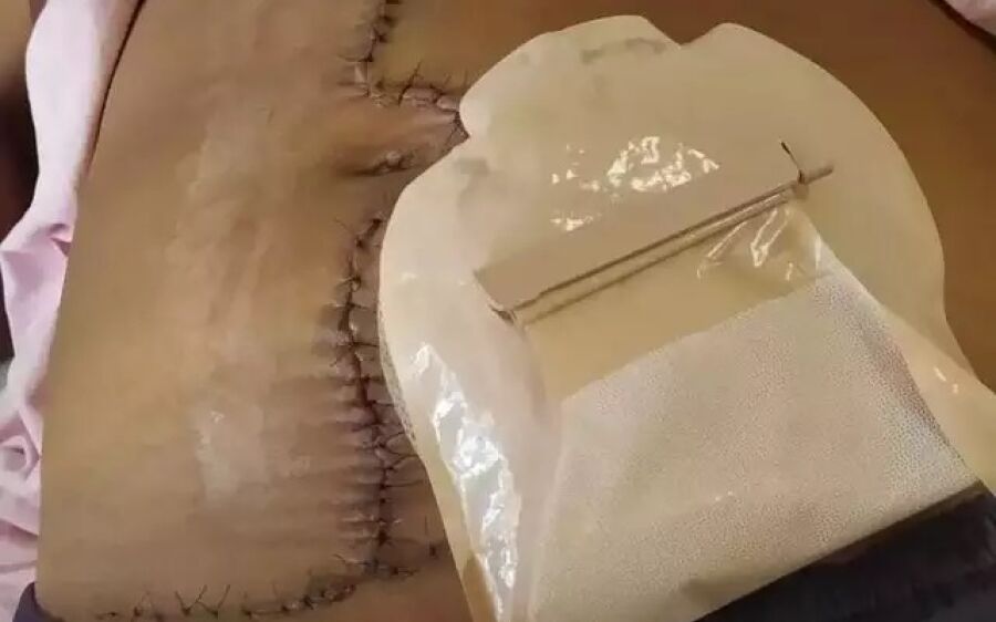 Mulher com gaze esquecida no corpo após parto agora vive com colostomia em MS