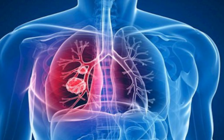 Tuberculose: longe de ser coisa do passado, doença volta a preocupar o Brasil