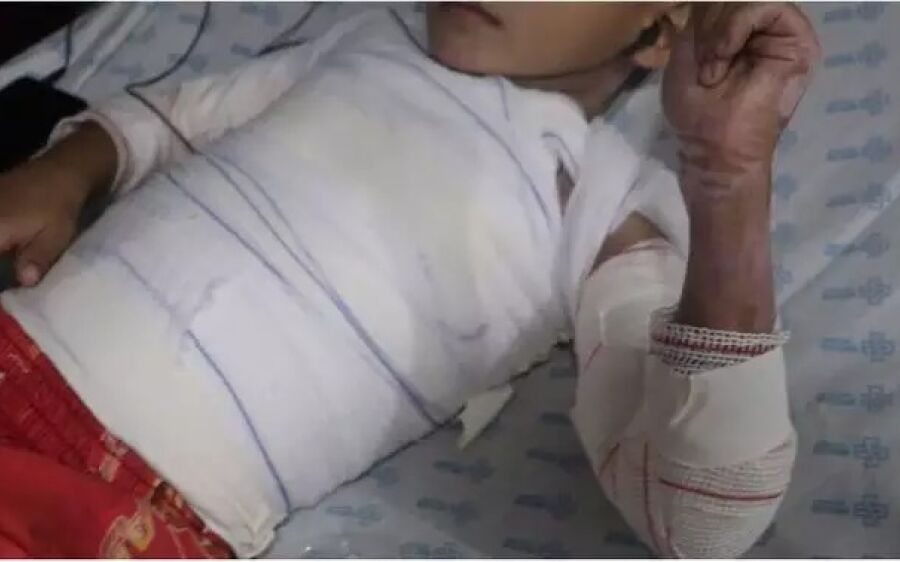 Queimaduras em crianças aumentam nas férias e maioria dos casos ocorre em casa