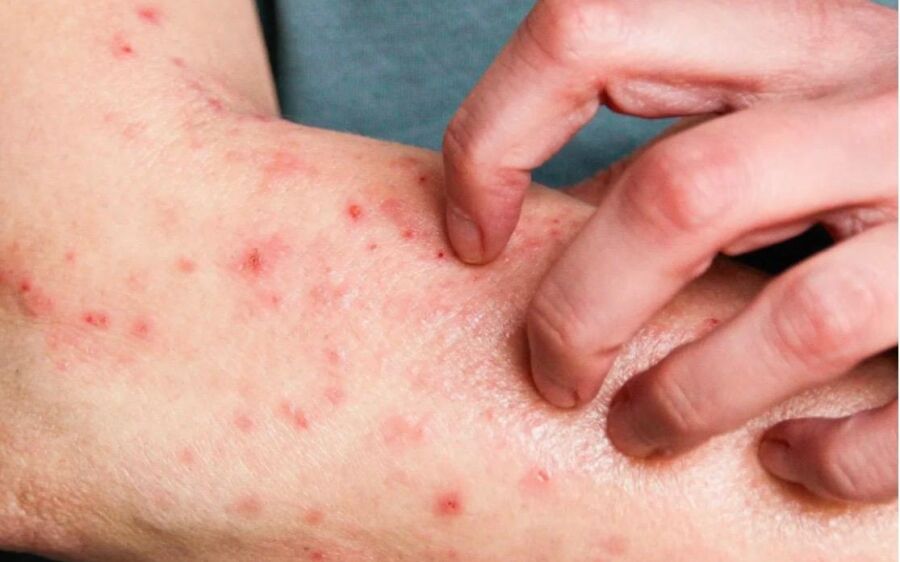  Porto Alegre confirma primeiro caso de Mpox em 2026