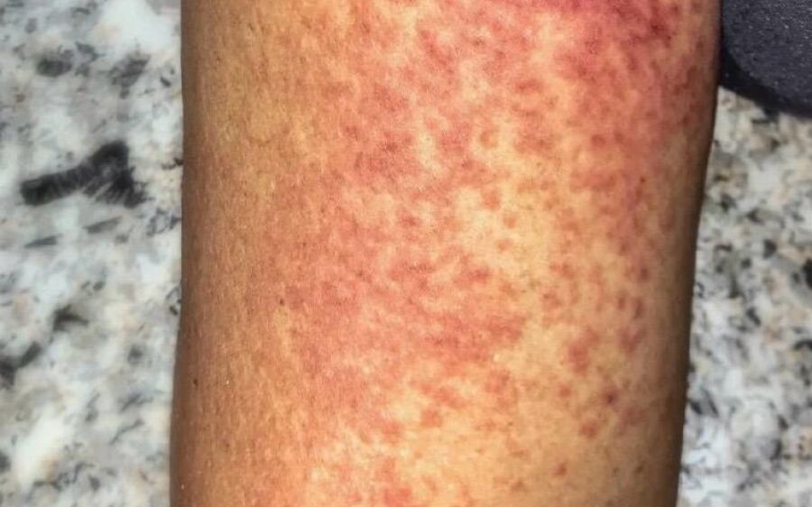 Coxim registra 1&ordm; caso confirmado de chikungunya e acende alerta após emergência em Dourados