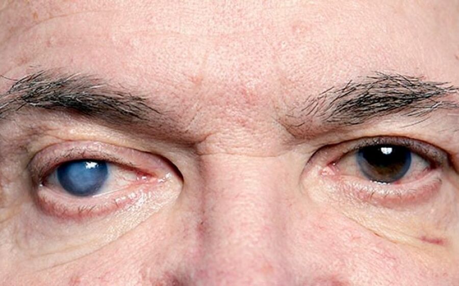 Glaucoma: doença silenciosa pode causar perda irreversível da visão se não for tratada