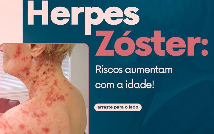 Herpes-zóster acende alerta em Coxim após moradores procurarem reportagem com relatos da doença