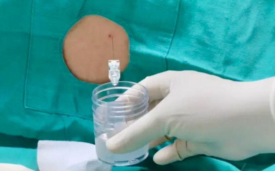 Mato Grosso do Sul registra 34 casos de meningite e 8 mortes em 2026, mas SES descarta surto