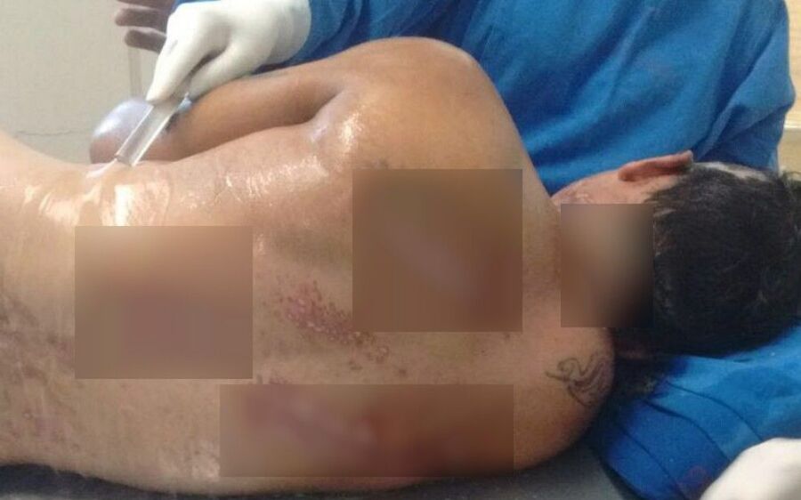 Serralheiro que levou choque 270 vezes maior que tomada recebe alta após 41 dias internado em MS