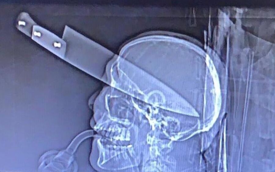 Homem sobrevive a facada no olho e é atendido com a arma ainda no crânio em MS