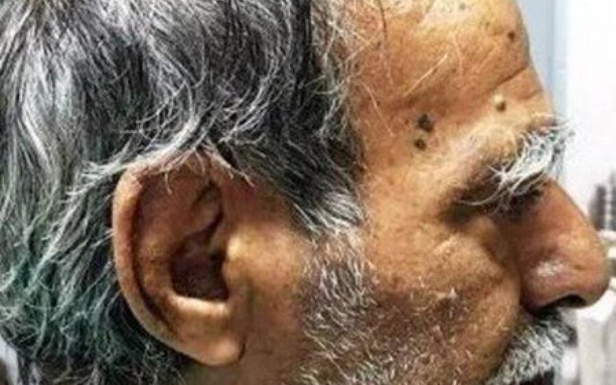 Homem tem 'chifre' de 10cm removido em cirurgia