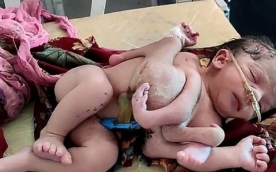 Bebê nasce com três mãos e quatro pernas devido à má formação