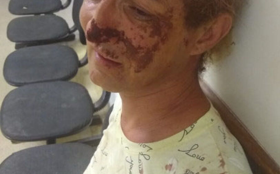 Transexual é agredida em Coxim e tem pedaço do nariz arrancado