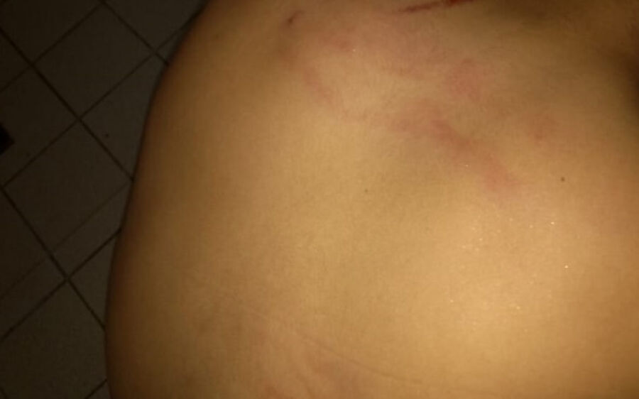 Urologistas tentam conter hemorragia para operar adolescente agredido por PM 