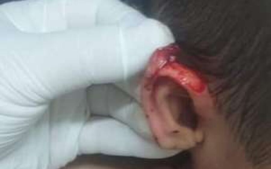 Criança de 3 anos tem orelha cortada com tesoura por coleguinha e mãe denuncia Ceinf