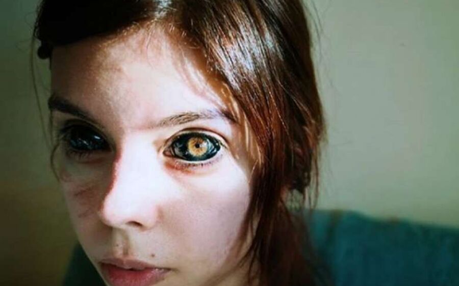Após perder parcialmente a visão, modelo polonesa processa tatuador que pintou seus globos oculares