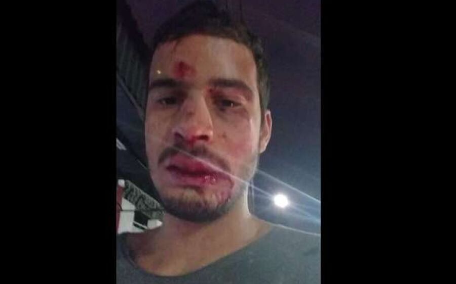 Motorista de aplicativo que apanhou de passageiros bêbados teve 6 dentes quebrados
