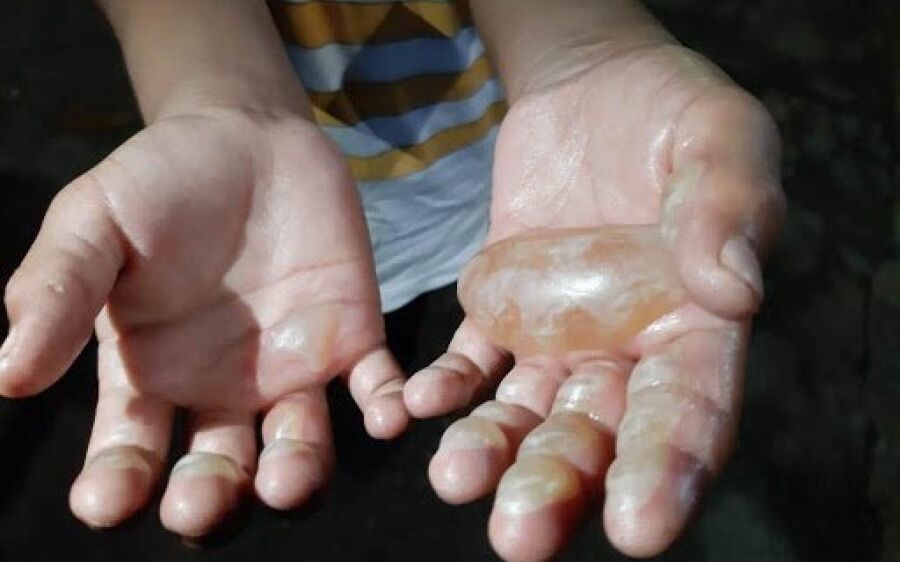 Menino de 6 anos tem mão queimada por mãe porque pegou dinheiro para levar à escola