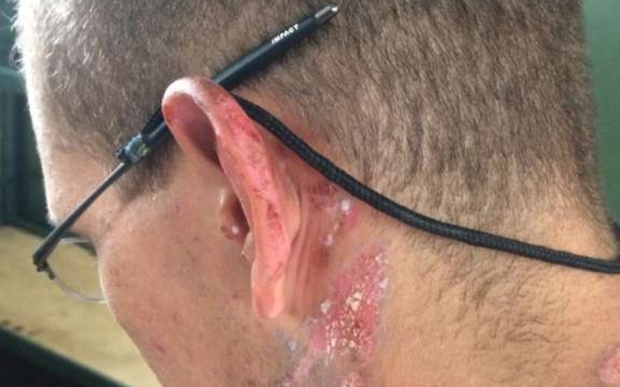 Sargento é denunciado por jogar álcool e atear fogo em recruta dentro de quartel em MS