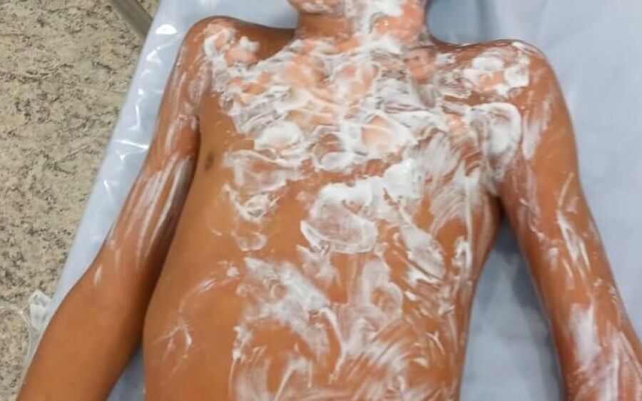 Menino de 8 anos socorrido em chamas após ser abandonado pela avó teve queimaduras no rosto e tórax